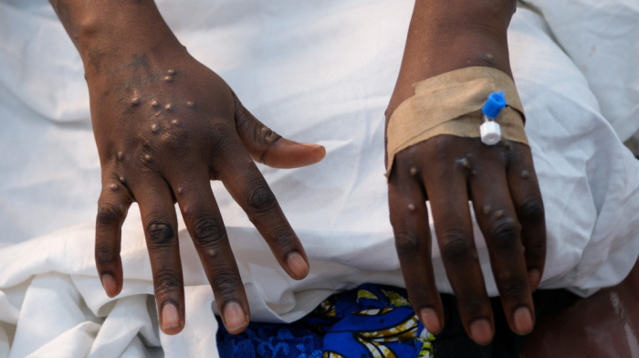 Africa Faces Mpox Crisis: 30,000 Suspected Cases Reach Record Levels