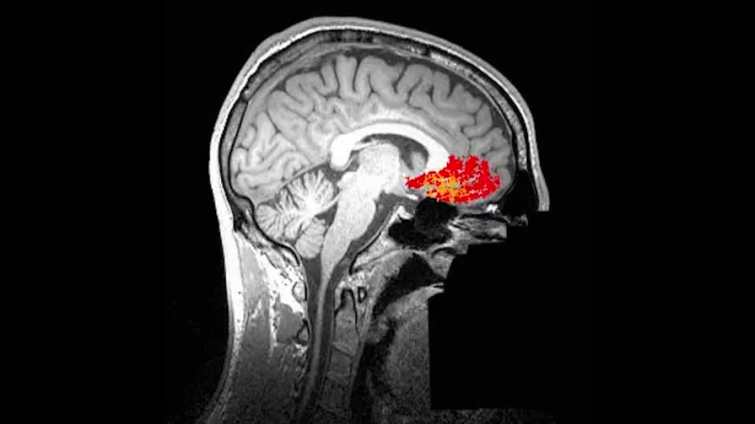 Scientists use AI to spot 'invisible' brain abnormalities