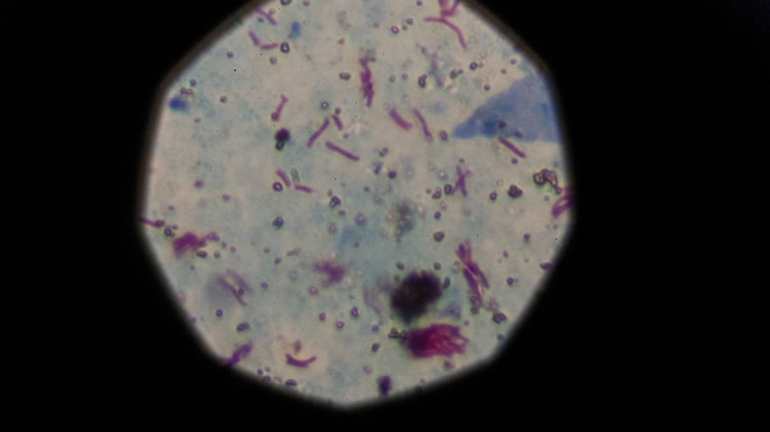 WHO warns as child tuberculosis cases in Europe rise 10% in 2023
