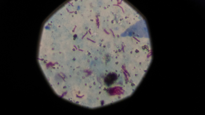 WHO warns as child tuberculosis cases in Europe rise 10% in 2023
