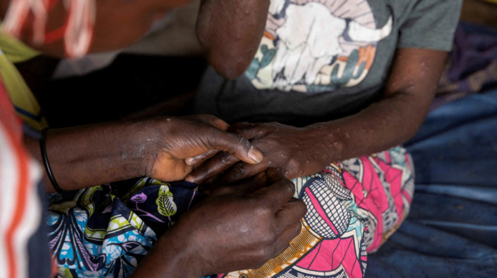 Ethiopia confirms first mpox death, five still infected