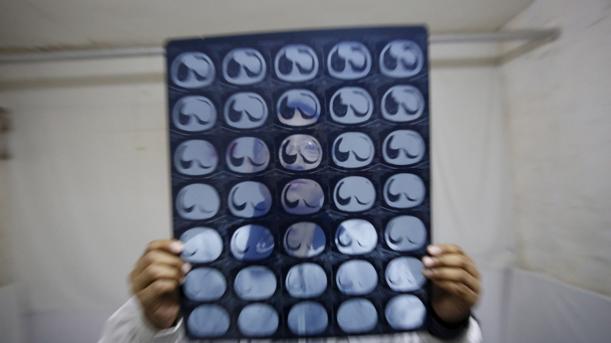 Prostate cancer blood test cuts death risk by 13%, long-term study finds