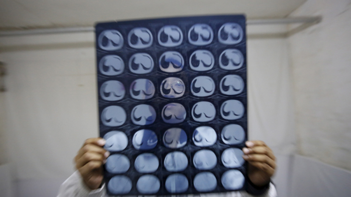 Prostate cancer blood test cuts death risk by 13%, long-term study finds