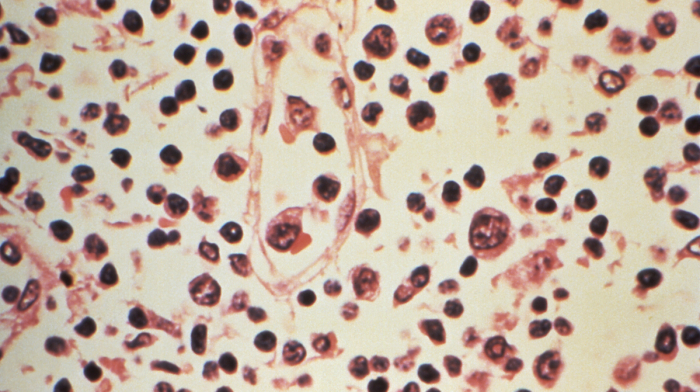 CDC evaluates risk level after deadly cruise ship hantavirus outbreak